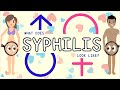 Syphilis: Types, Sign and symptoms, Diagnosis, Treatment