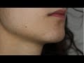 UPDATE 1: FACIAL HAIR ELECTROLYSIS VS LASER HAIR REMOVAL | PCOS