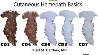Cutaneous Hemepath 101 (Skin Lymphoma, Leukemia, & Histiocytic Infiltrate Basics) Hematopathology
