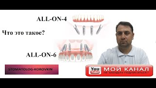 Технология ALL-ON-6 и ALL-ON-4. Что это?
