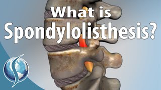 What Is Spondylolisthesis?