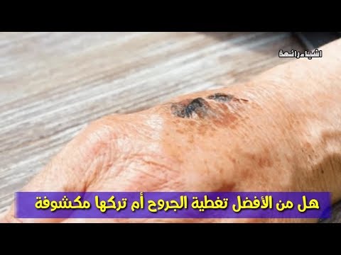 هل من الأفضل تغطية الجروح أم تركها مكشوفة