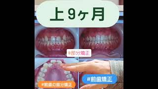 ★部分矯正★歯がガタガタしてるのをキレイにしたい★上9ヶ月、来院回数19回