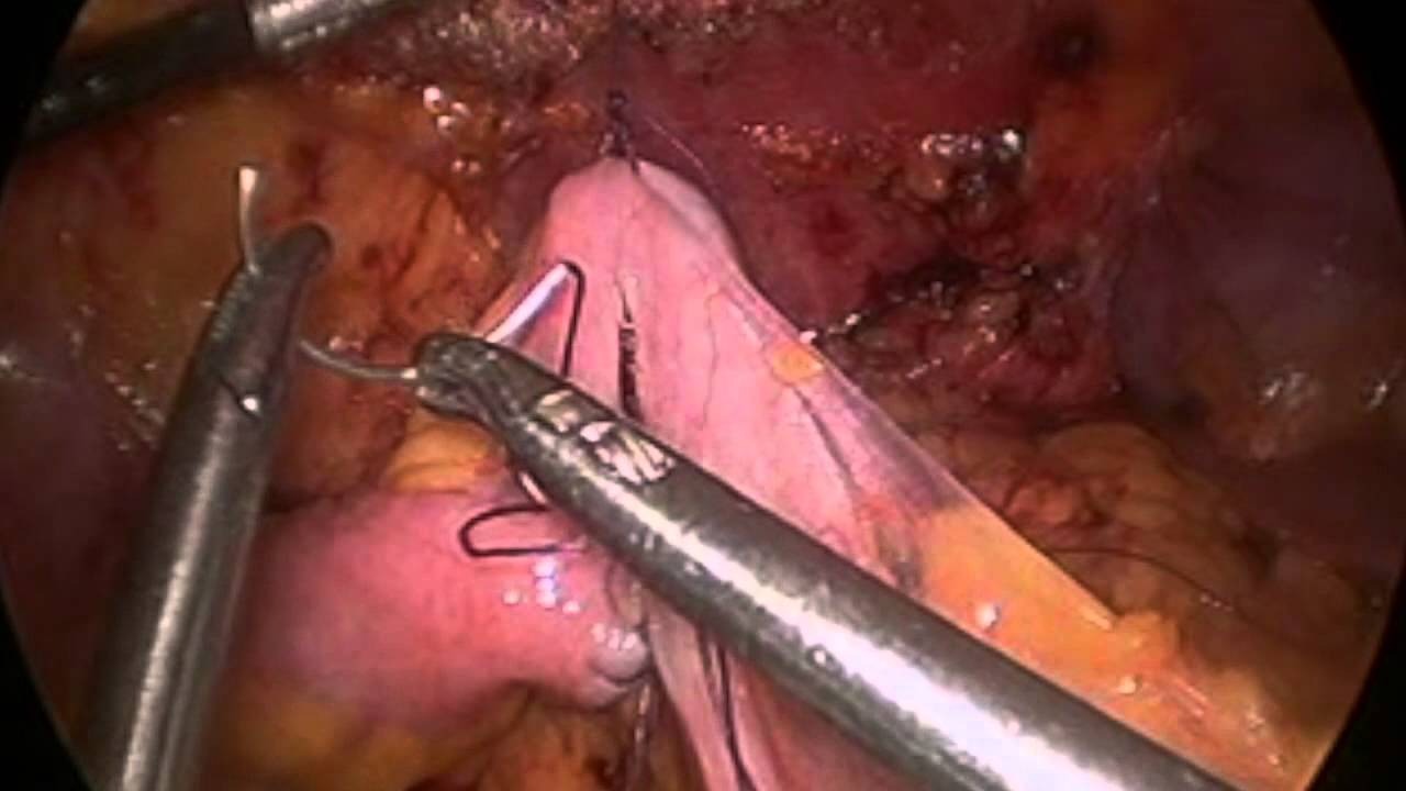 laparoscopic intracorporeal bowel anastomosis youtube anastomosis