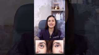 Can cucumbers and tea bags really help with dark circles??? || Dr Jushya Sarin ||