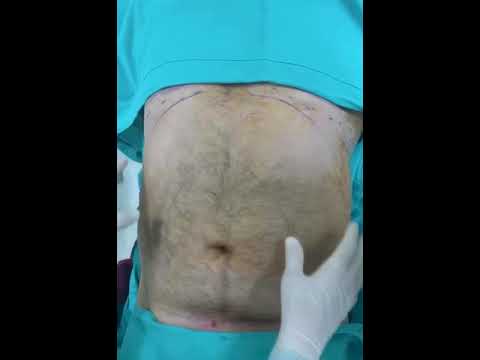 Karın Bölgesi Liposuction Yağ Aldırma Ameliyatı