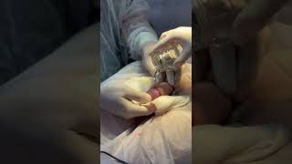Операция циркумцизио (обрезание крайней плоти) в Клинике Николая Доценко