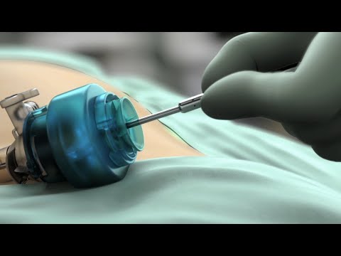 TELEFLEX MICROLAPAROSCOPY PLATFORM ANIMATION