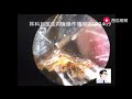 Another huge cerumen/earwax in the ear,16mins