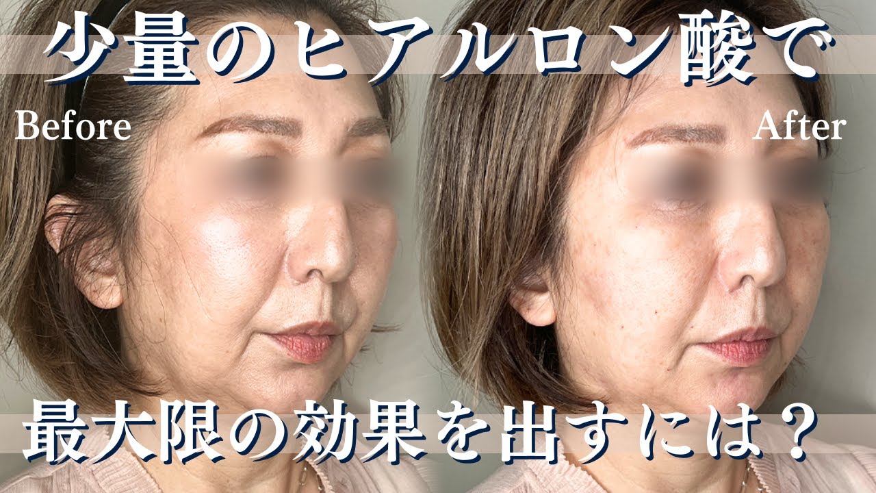 【ヒアルロン酸】少量で最大限の効果を出す秘訣！症例を元に徹底解説します！