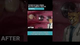 어금니 흔들림, 발치 즉시 보험 임플란트로 해결! 🦷 #치주염 #임플란트수술 #보험임플란트 #shorts
