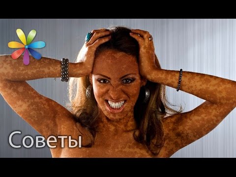 хлоазма фото на теле смотреть