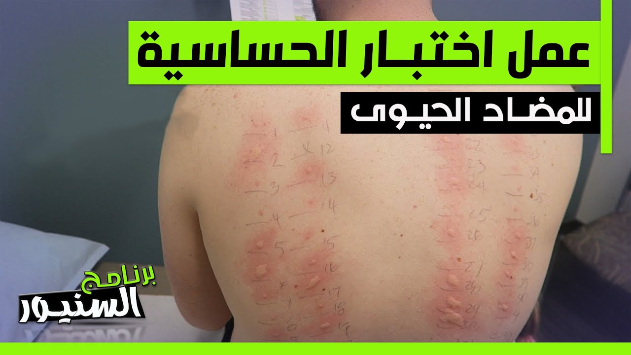 طريقة عمل اختبار الحساسيه للمضاد الحيوى والبنسلين  allergy test