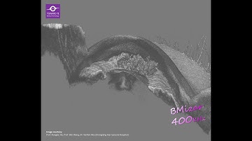 3D reconstruction of iridoschisis by full range Swept Source OCT, BMizar from TowardPi