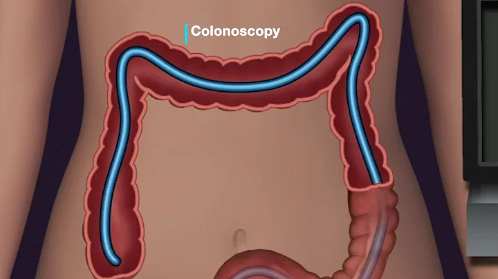 Mayo Clinic Minute - Who should be screened for colorectal cancer?