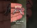Lower cast partial denture 😬😬😬#apexdental #splittooth #dentistry #partialdenture #orthodontist