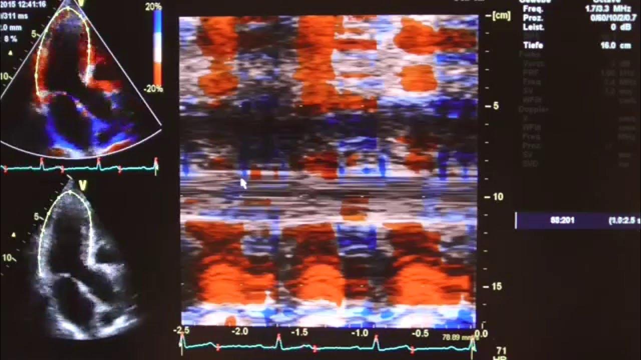 Colour curved anatomical Mmode (CAMM) of strain (APLAX view) YouTube