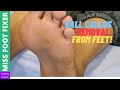 Ball Callus removal from feet | Miss Foot Fixer |  Marion Yau