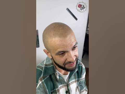 Мужское облысение можно скрыть надолго татуировкой волос ...