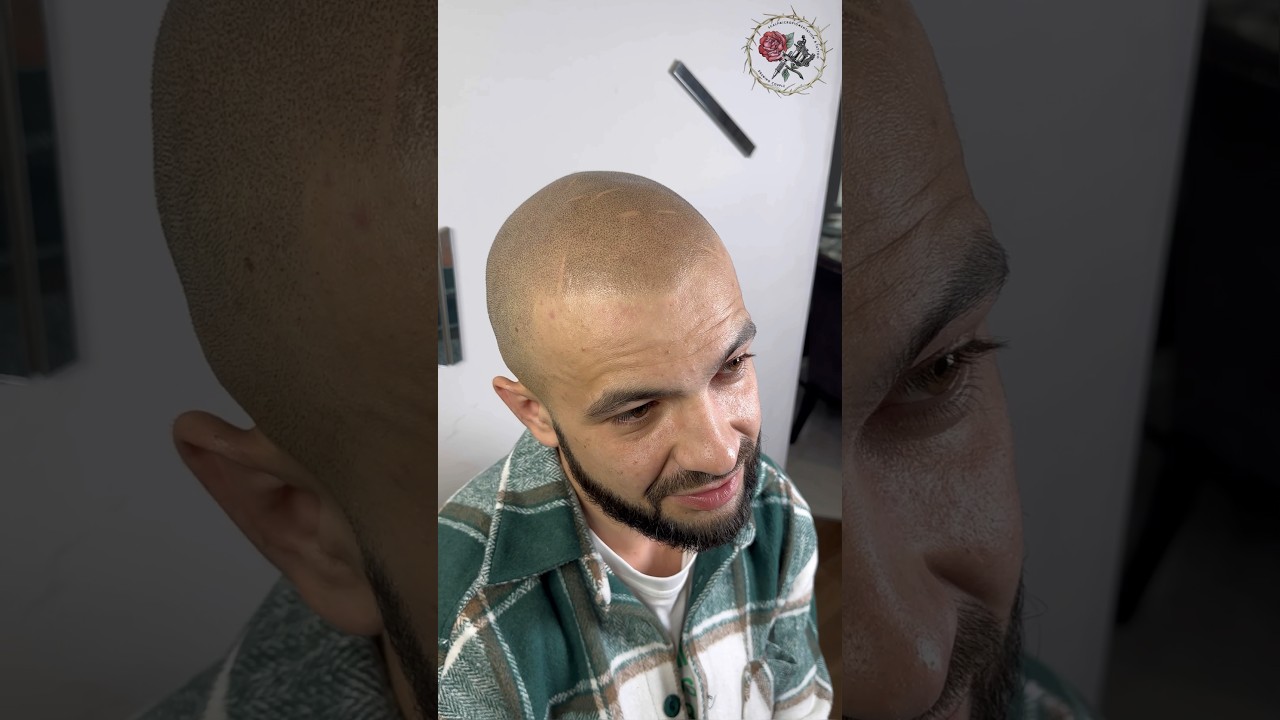Мужское облысение можно скрыть надолго татуировкой волос! Трихопигментация. Scalp micropigmentation