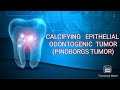 CALCIFYING EPITHELIAL ODONTOGENIC TUMOR PINDBORGS TUMOR CALCIFYING EPITHELIAL ODONTOGENIC TUMOR PINDBORGS TUMOR