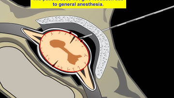 Animation of Injury Due to Epidural (Adobe Flash) HD