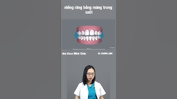 Niềng Răng khấp khểnh | Nha Khoa Minh Châu