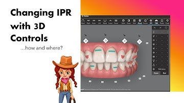 Invisalign ClinCheck - Changing IPR with 3D controls