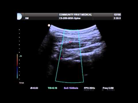 Ultrasound Guided Occipital