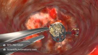 Medical Animation Of Co2 Laser Surgery