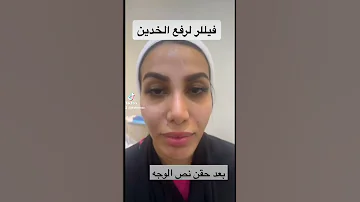 فيلر لرفع الخدين 