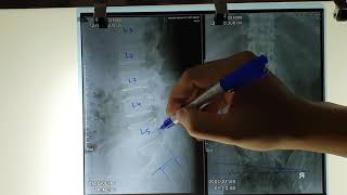 Nắn Chỉnh Xương Cùng và Đốt Sống L5, Đốt Sống S2 -- Điều Trị ĐAU THẦN KINH TỌA do THOÁT VỊ ĐĨA ĐỆM.