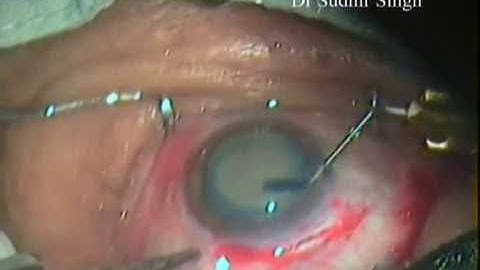 Intra Tunnel Phaco Fracture Technique of the Manual SICS By Dr Sudhir Singh
