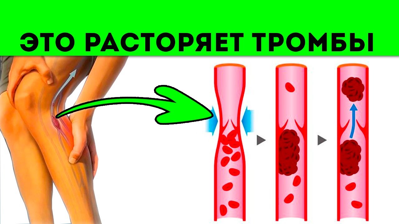 Продукты разжижающие тромбы в сосудах