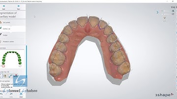 Digital teeth segmentation by 3shape (Workflow by Shereef Shahen)