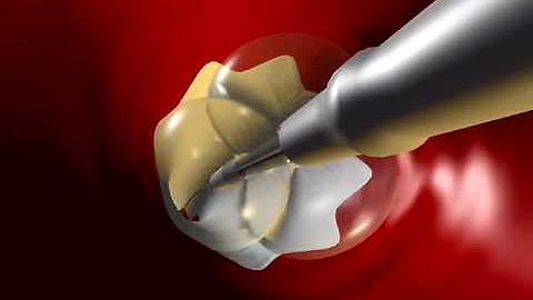 animation thoracic endograft