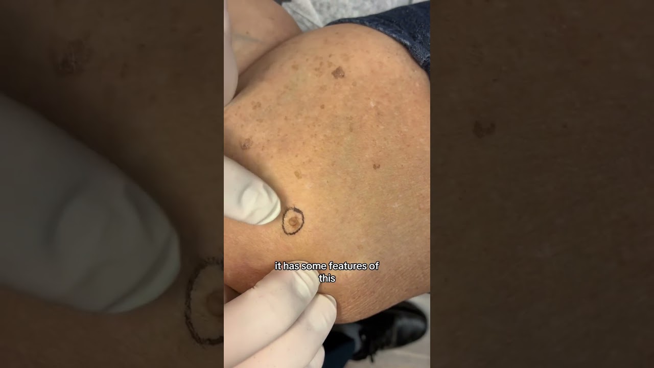 Dermatologist with 50 Years Experience Shows Different Mole Types on Patient #moles #moletypes
