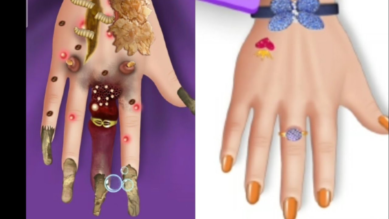 asmr-the-best-treatment-for-hand-s-and-finger-removal-treatment