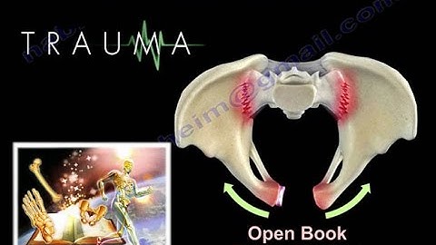 Damage Control Orthopaedics - Everything You Need To Know - Dr. Nabil Ebraheim