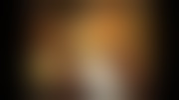 ERCP after gastrectomy (Billroth II reconstruction)