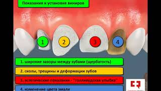 Виниры: установка, показания, вид зубов до и после