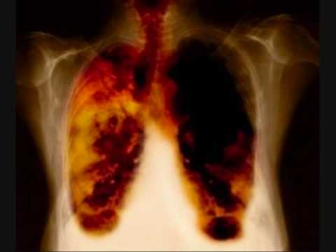 Fotografias del cancer de pulmon