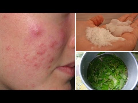 7 Cystic Acne Home Remedies that Really Work