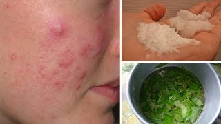 7 Cystic Acne Home Remedies that Really Work screenshot 4