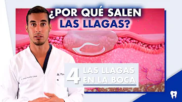 ¿Cuándo debo preocuparme por las úlceras bucales?