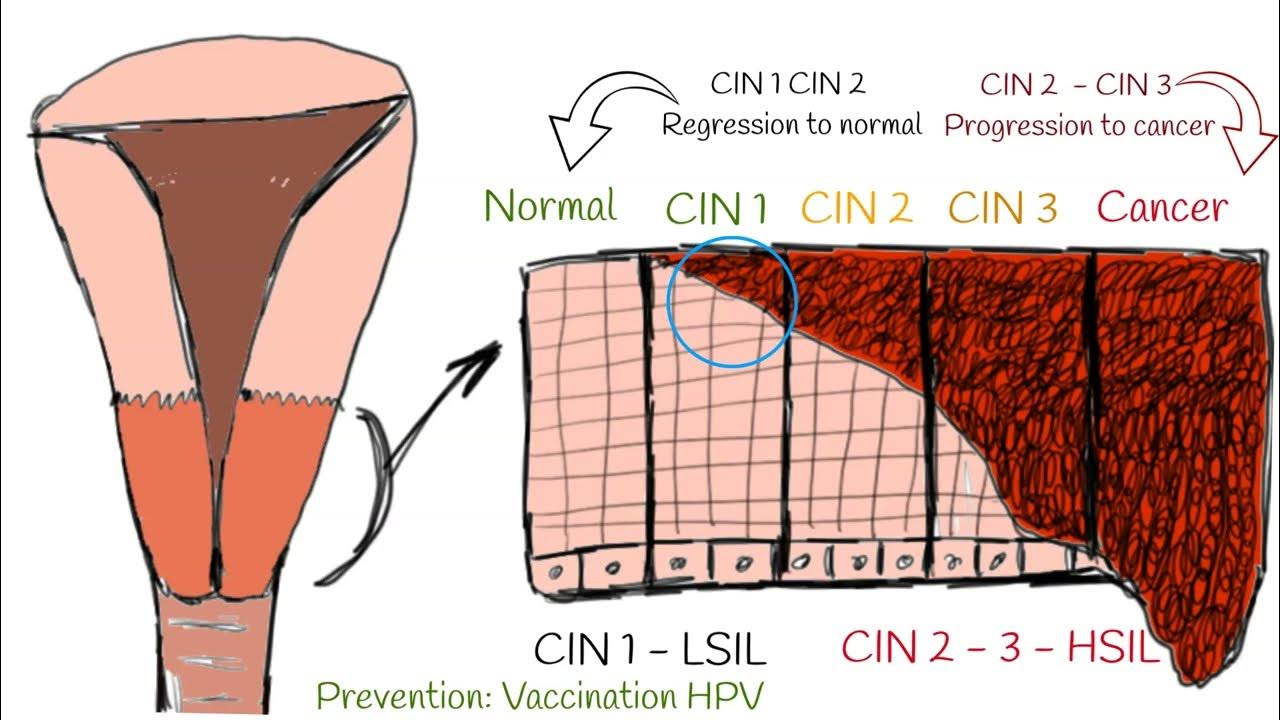 Cin cervical intraepithelial neoplasia cervical dysplasia cin i
