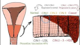 CIN - Cervical intraepithelial neoplasia (cervical dysplasia). CIN I; CIN II; CIN III explained