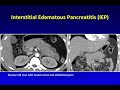 MDCT of Acute Pancreatitis Part 1