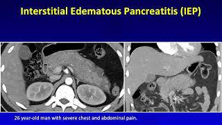 MDCT of Acute Pancreatitis Part 1