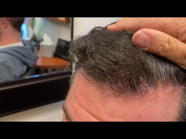 Dallas FUE Hair Transplant Close-Up